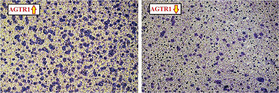 AGTR1 downregulation attenuates breast cancer cell invasion